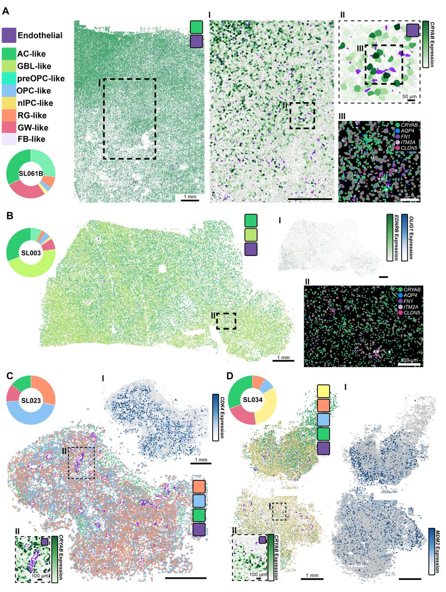 MossiAlejandro's tweet photo. Finally, we observed specific tumor-stroma interactions, such as the interaction of AC-like CRYAB+ tumor cells with the endothelium, consistently across GBM tumors independently of mutational profile and also present in oligodendroglioma. https://t.co/KnJIwhxY2r