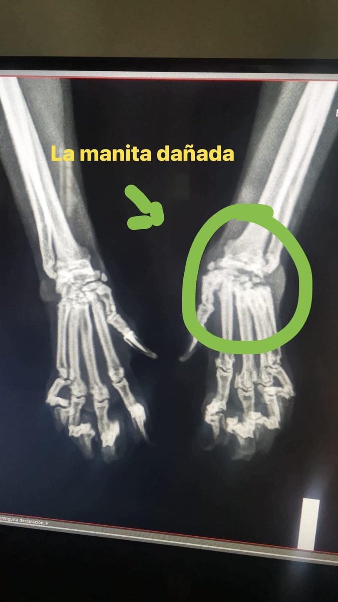 Mriadelia's tweet photo. @LuannaG8  hola Luanna , mil disculpas por la confianza, quería ofrecerte un númerito de una rifa a favor de una gatita sin hogar, vale ₡1500, a ella le hicieron una biopsia y se le diagnosticó sinuvitis linfoplasmocitaria y neutrofilica con procesos de reparación, enfermedad de los huesitos, tiene sus patitas izquierdas dañadas pero el dr ya le envió tratamiento para detener l enfermedad, por si te gustaría el premio es una canasta de víveres, sorteo 10 de setiembre, sinpe 87030105 María Castro gracias