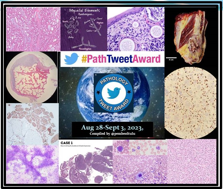 1/57 we have about 55 great #pathtweet, in this #PathTweetAward week; 
Aug28-Sept 3 educational tweets that is compiled by @pembeoltulu is here. You can see all tweets under this main tweet.
@PathTweetAward @Baskotacytopath