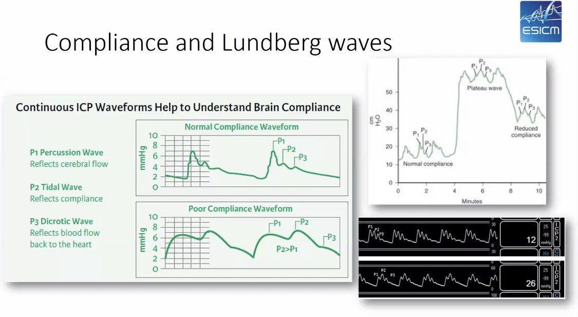 ca_iaquaniello's tweet photo. Avoid your brain giving you the middle finger! Go on, monitor!

#Brainmasters #ESICM https://t.co/KuMzmYQRSc