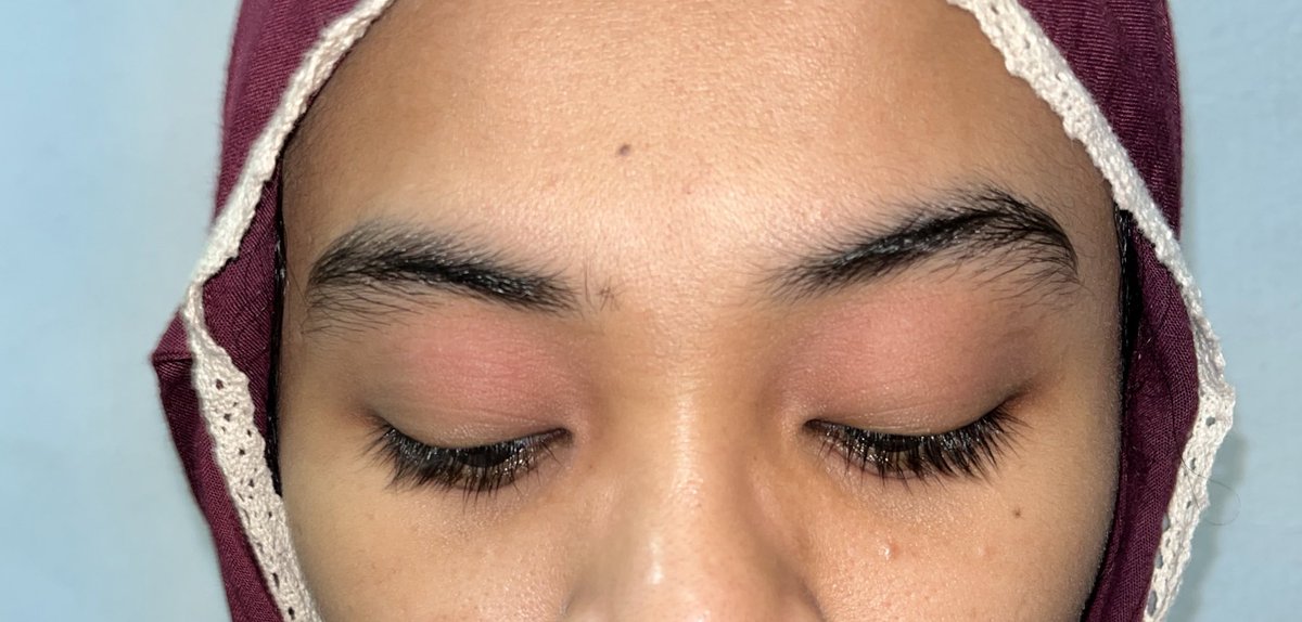 centangbiru_'s tweet photo. another merah2 ak,,

ini adalah kali ketiga dlm thn 2023 mata gw tbtb merah kering agak gatel tanpa seban yg jelas. dampak +nya cuma dr jauh keliatan pake esedo, sisanya nyiksaaa😔💔 https://t.co/SQNoiEHYvA