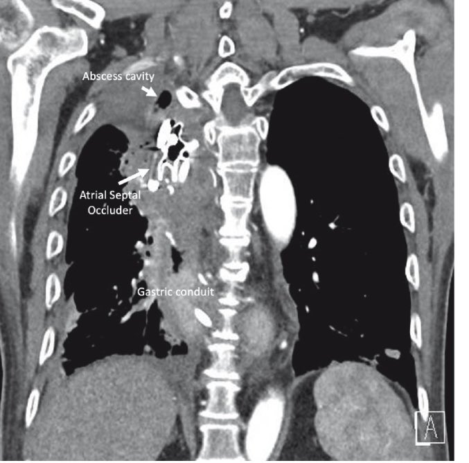 Innovative use of #ASD occluder for treatment of esophageal thoracic fistula led by our upper GI colleagues! #sgh #nhcs thieme-connect.com/products/ejour…