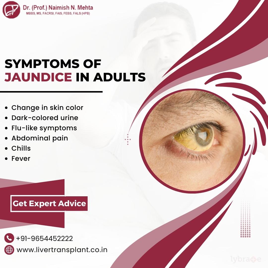 mehta_naimish's tweet image. Symptoms of Jaundice in Adults
- Change in skin color
- Dark-colored urine
- Flu-like symptoms
- Abdominal pain
- Chills
- Fever

#jaundice #LiverProblem #liverhealth #liverdoctor #DrNaimishMehta