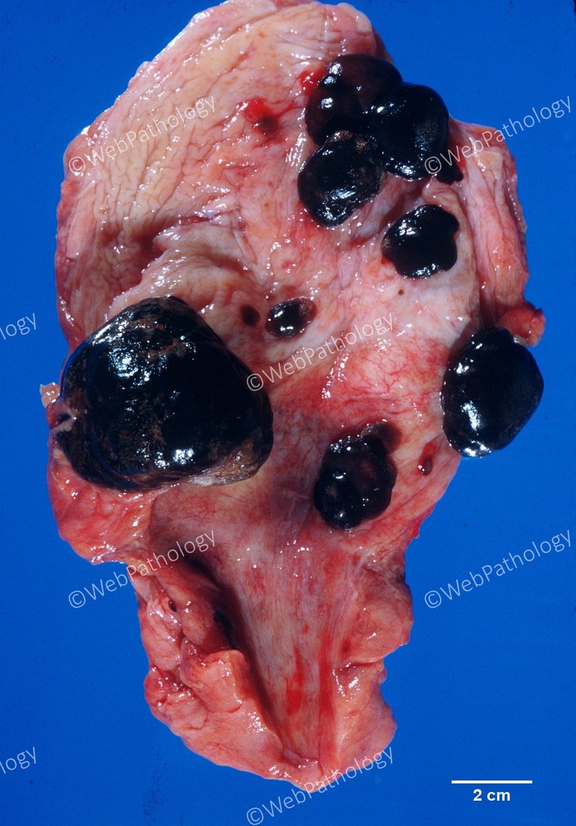 Old autopsy photo. Metastatic melanoma in urinary bladder. There were widespread mets in brain, lungs, liver, GI and GU tracts. #pathology #pathtwitter #melanoma