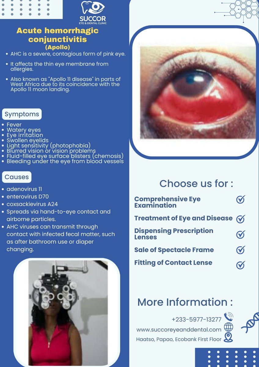 SuccorEnD's tweet photo. Acute hemorrhagic conjunctivitis is a contagious form of pink eye. It affects the thin membrane form allergies. It is also known was Apollo 11 disease due to its coincidence with the Apollo 11 Mon landing. 
#succorED #eyecare #health #healthcare #accra #showdown #dentalcare #bbn https://t.co/eoenlouibW