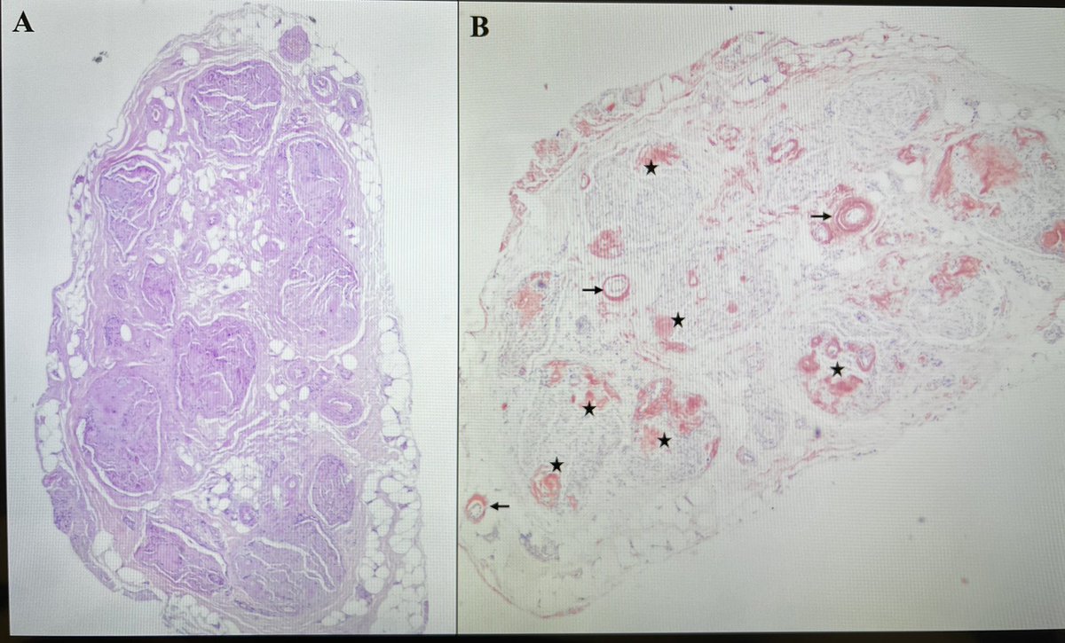 Amyloid polyneuropathy in a patient with Waldenströn macroglobulinemia 

pubmed.ncbi.nlm.nih.gov/37661503/