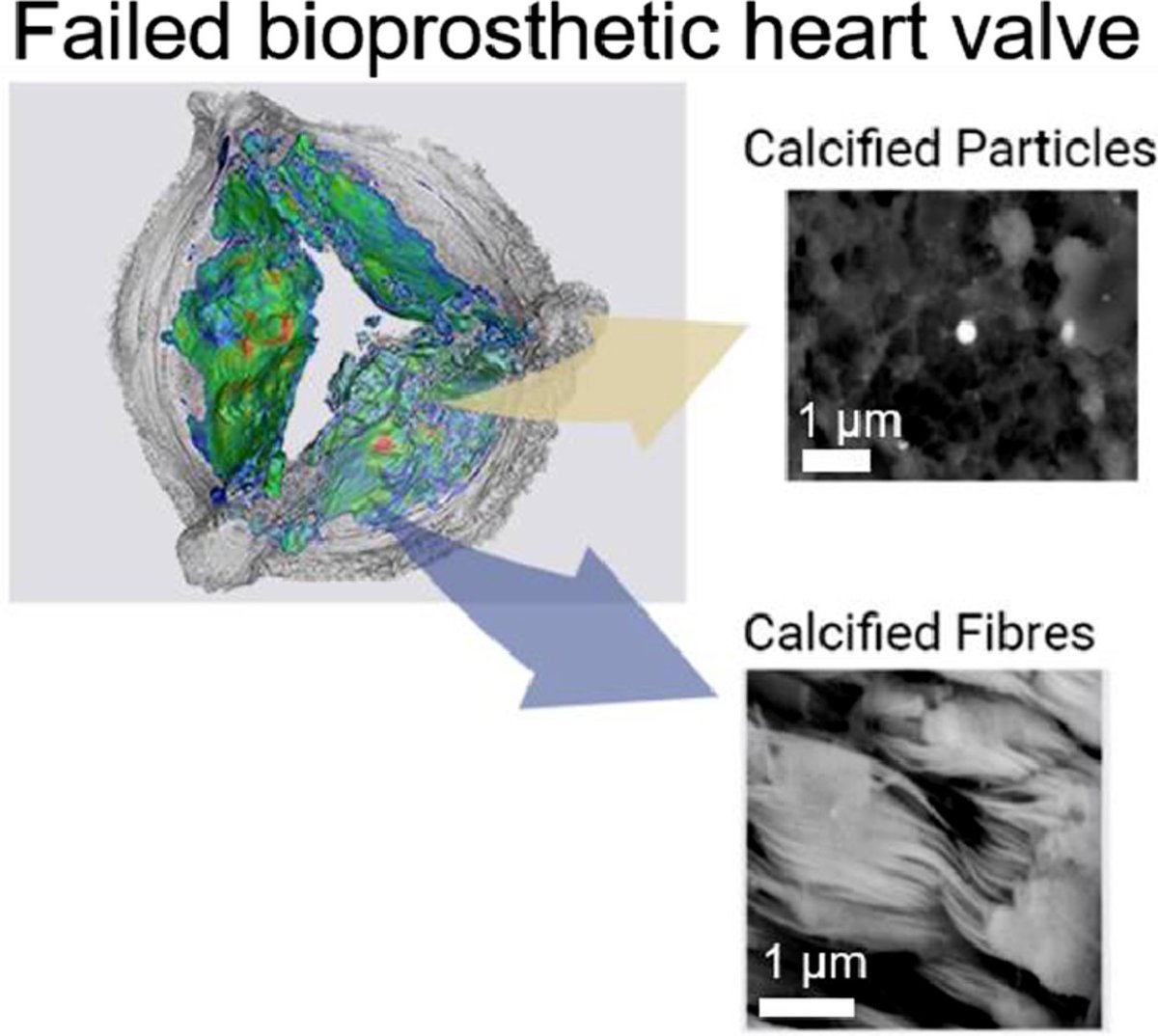 ActaBio's tweet photo. Professor Inge Herrmann: Multiscale multimodal characterization and simulation of structural alterations in failed bioprosthetic heart valves @IngeKHerrmann @Empa_CH @ETH_en @LondonNanotech https://t.co/YQGWgSbxgp https://t.co/Fh33reBt5Z