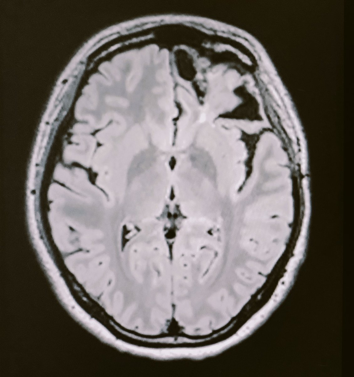 JRBneuropsiq's tweet photo. Previously, the patient had no relevant mental health problem. After this brain lesion -unfortunately- things changed. What kind of cognitive, affective, behavioral changes would you expect?
#Neuropsychiatry Cognitive #Neurology #Neuropsychology https://t.co/6TzKlsIkVF