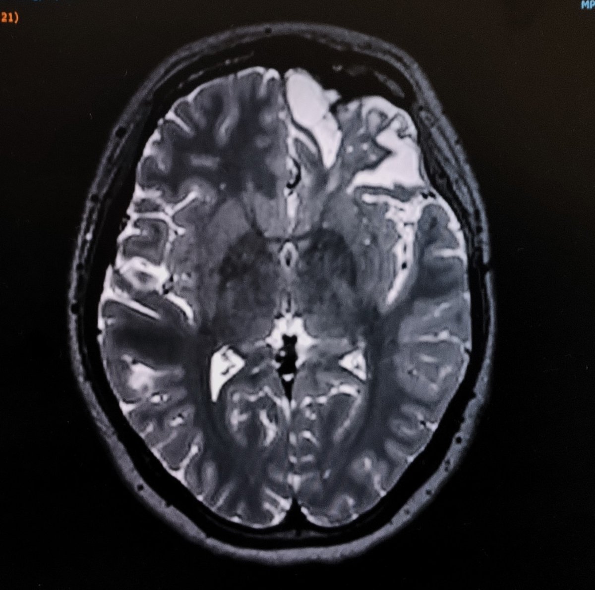 JRBneuropsiq's tweet photo. Previously, the patient had no relevant mental health problem. After this brain lesion -unfortunately- things changed. What kind of cognitive, affective, behavioral changes would you expect?
#Neuropsychiatry Cognitive #Neurology #Neuropsychology https://t.co/6TzKlsIkVF