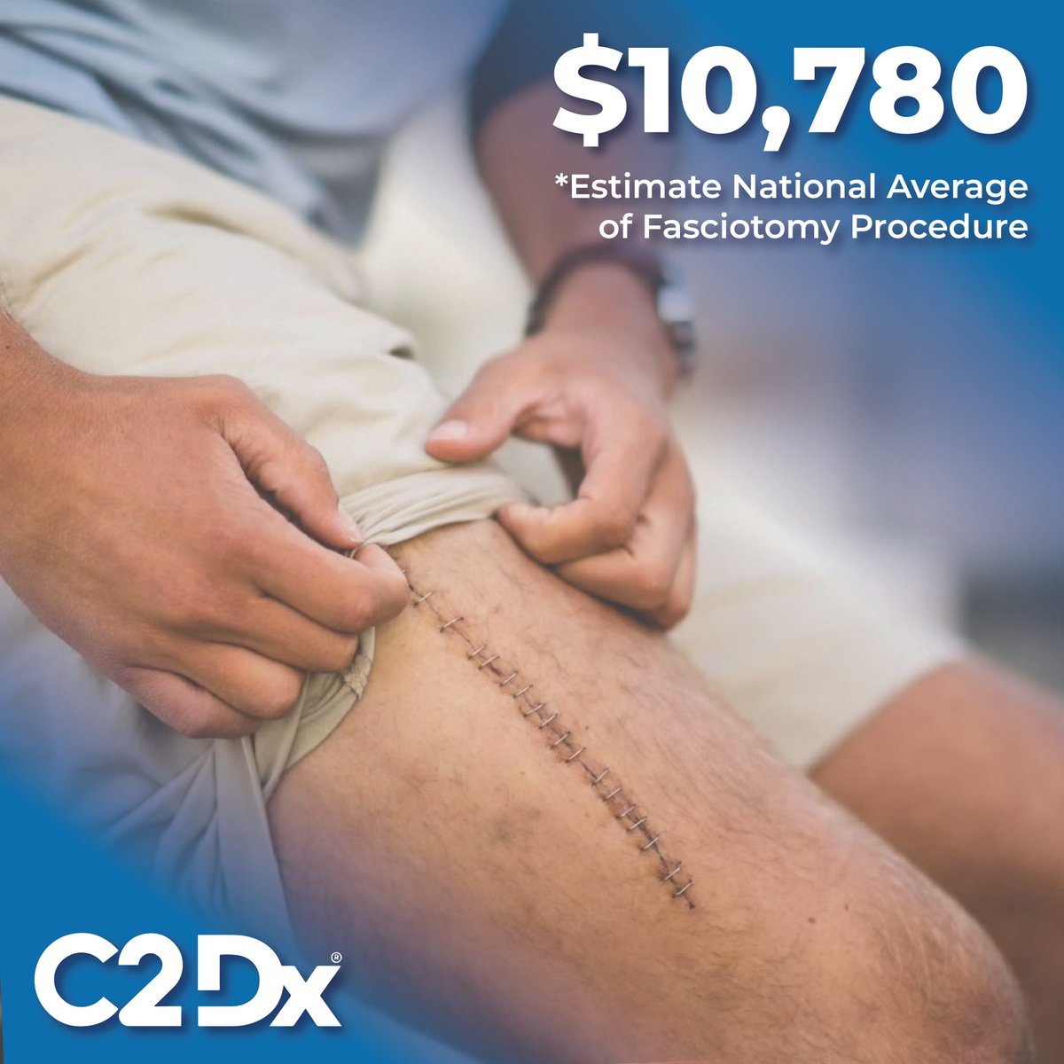 With the estimated cost for a fasciotomy at over $10,000, increasing patient awareness is crucial. 

Learn more about acute compartment syndrome pathophysiology, diagnosis, and management in this new white paper: scnv.io/ACSWhitePaper 

#C2Dx #CompartmentSyndrome #Fasciotomy