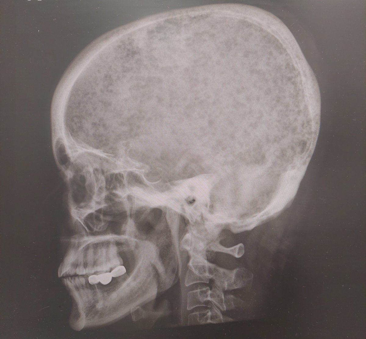 AbbasiMuqtadir's tweet photo. Medicine residents, hypercalcemia, renal failure, bone pains and this picture, will tell you one obvious diagnosis? https://t.co/eeLrkYhmsy