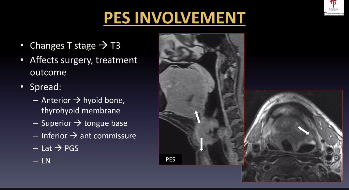 ESHNR (@eshnrsociety) on Twitter photo T-staging guides treatment. Whilst MR is gold standard for assessment of cartilage involvement, CT (esp. DE-CT) can be helpful. Look carefully for pre-epiglottic fat invasion. <a href="/ashnr/">Rashid Naseem</a> #hnrad T-staging guides treatment. Whilst MR is gold standard for assessment of cartilage involvement, CT (esp. DE-CT) can be helpful. Look carefully for pre-epiglottic fat invasion. <a href="/ashnr/">Rashid Naseem</a> #hnrad