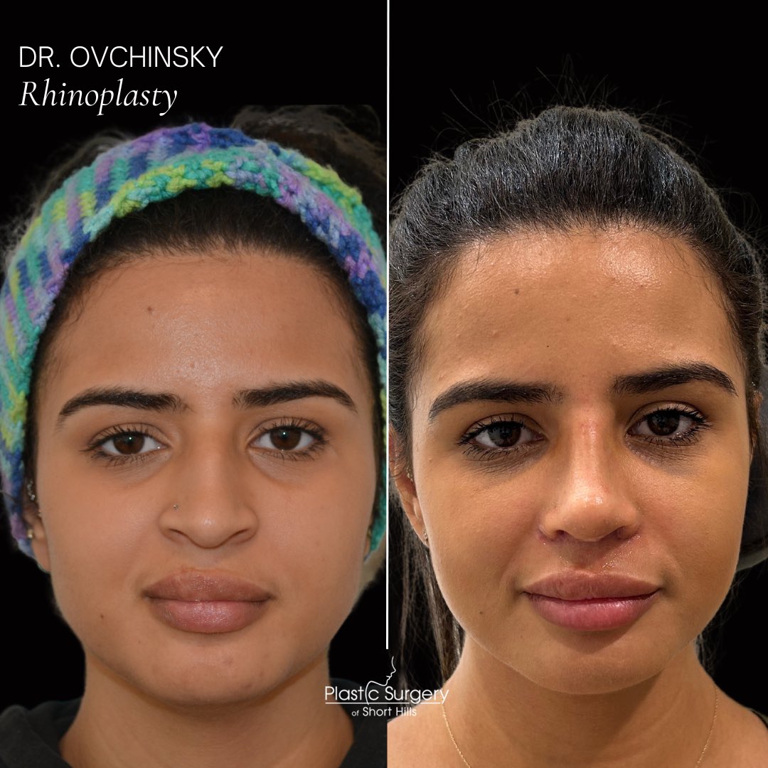 DrOvchinsky's tweet photo. Incredible rhinoplasty transformation 1 week post op🙌🏼 I smoothed out my patient’s nasal bridge, lifted the tip, &amp; narrowed the front of her nose to create a beautiful natural new shape. Rhinoplasty surgery is life changing &amp;  my patient is feeling so confident with her new look! https://t.co/kz7JIwCBfH