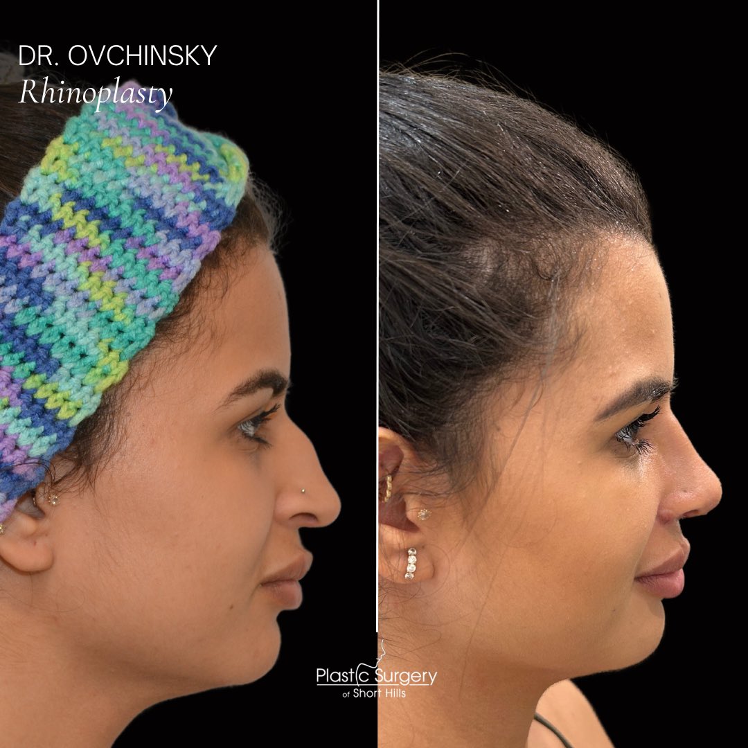 DrOvchinsky's tweet photo. Incredible rhinoplasty transformation 1 week post op🙌🏼 I smoothed out my patient’s nasal bridge, lifted the tip, &amp; narrowed the front of her nose to create a beautiful natural new shape. Rhinoplasty surgery is life changing &amp;  my patient is feeling so confident with her new look! https://t.co/kz7JIwCBfH