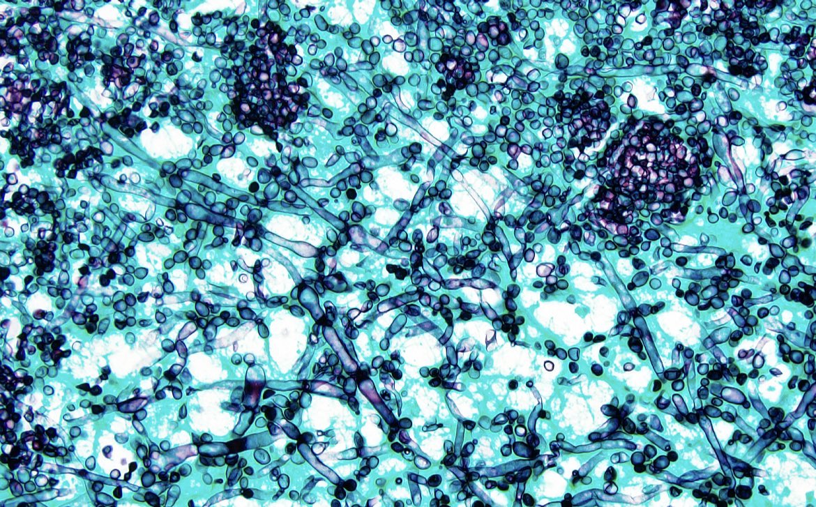 This is an IMPRESSIVE case of intracranial Candida infection. GMS stain demonstrates nicely the mixture of yeast forms and  pseudohyphae. #neuropath #PathTwitter 🧠🔬