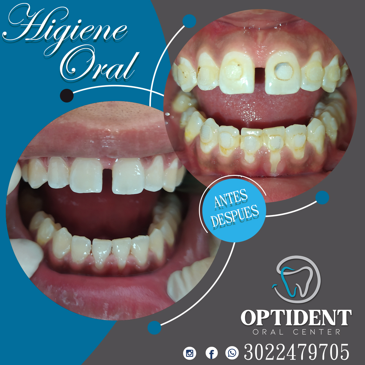 OptidentOralCen's tweet photo. *¡Ven y déjanos cuidar de tu sonrisa!* 🦷😁

Aquí encontraras profesionales que te ayudaran a que tu sonrisa resalte y tu confianza vuelva ✨💙. *Recuerda, tu sonrisa habla mucho de TI*. 🤩
#Higiene  #SaludBucal #optidentoralcenter  #DientesSanos  #Higieneoral #yumbo #odontologia https://t.co/HrGthjPRHE