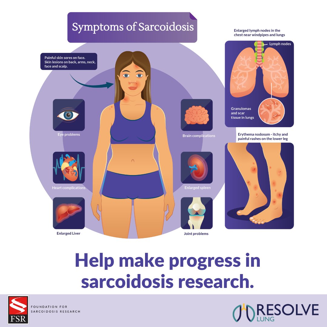 StopSarcoidosis's tweet photo. Do you have multi-organ symptoms of sarcoidosis?  You may still be eligible for a new clinical trial. Learn more about RESOLVE-Lung and see if you are eligible here: https://t.co/KJ829sfvYC 

#sarcoidosis #sarctwitter #raredisease #pulmonary #clinicaltrial https://t.co/oHDNxXnlZo