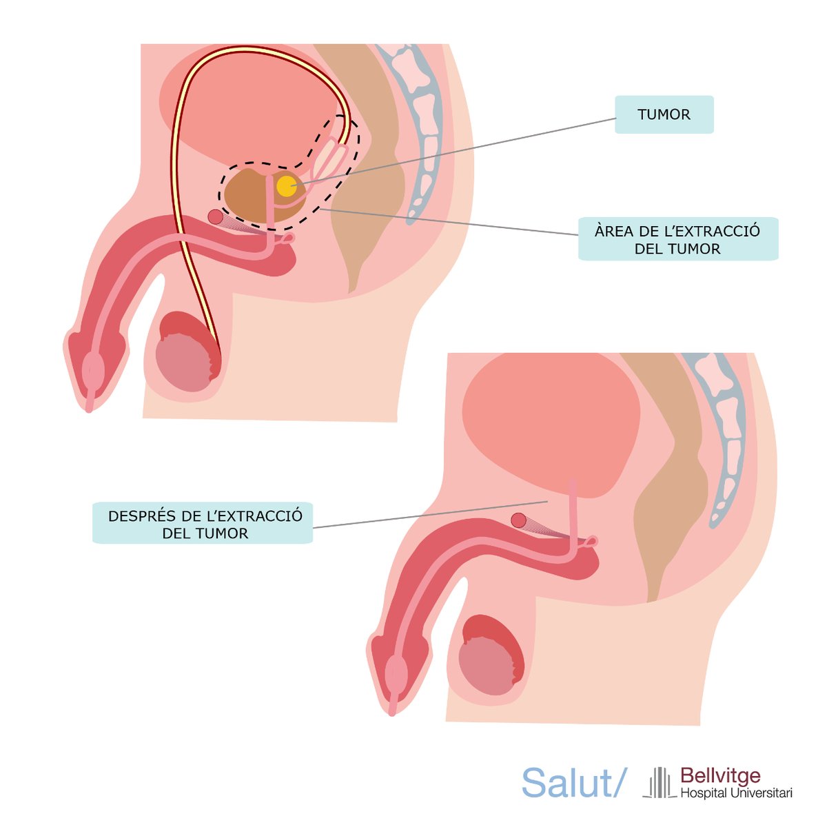 Hospital Universitari Bellvitge | HUB tweet media