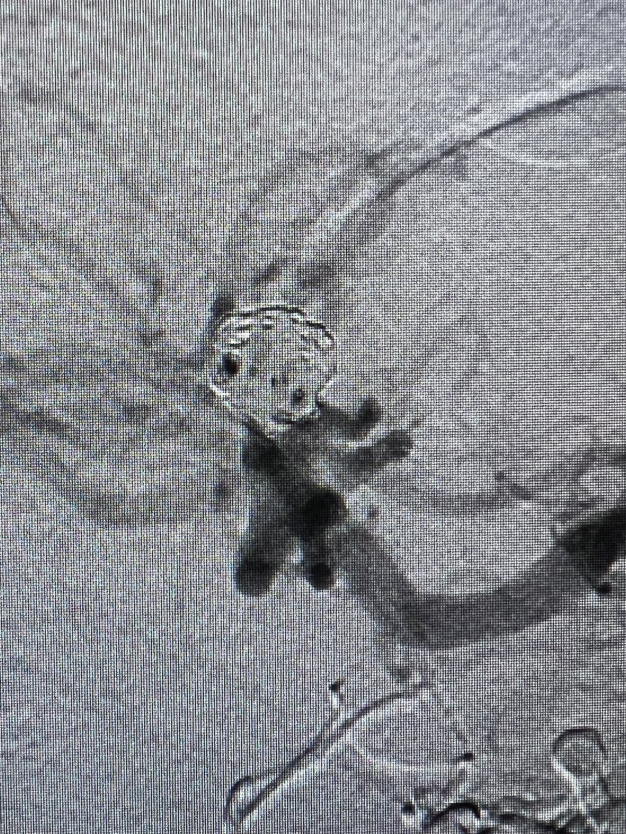 I give random radiographic shapes I encounter everyday some sorts of symbolic meanings. Here, this coiled aneurysm looks like a happy dancer. It’s got some cool coils and it’s secured. Maybe that’s why it looks so happy. 
#neurosurgery #MedTwitter #residency #medicine #artistic