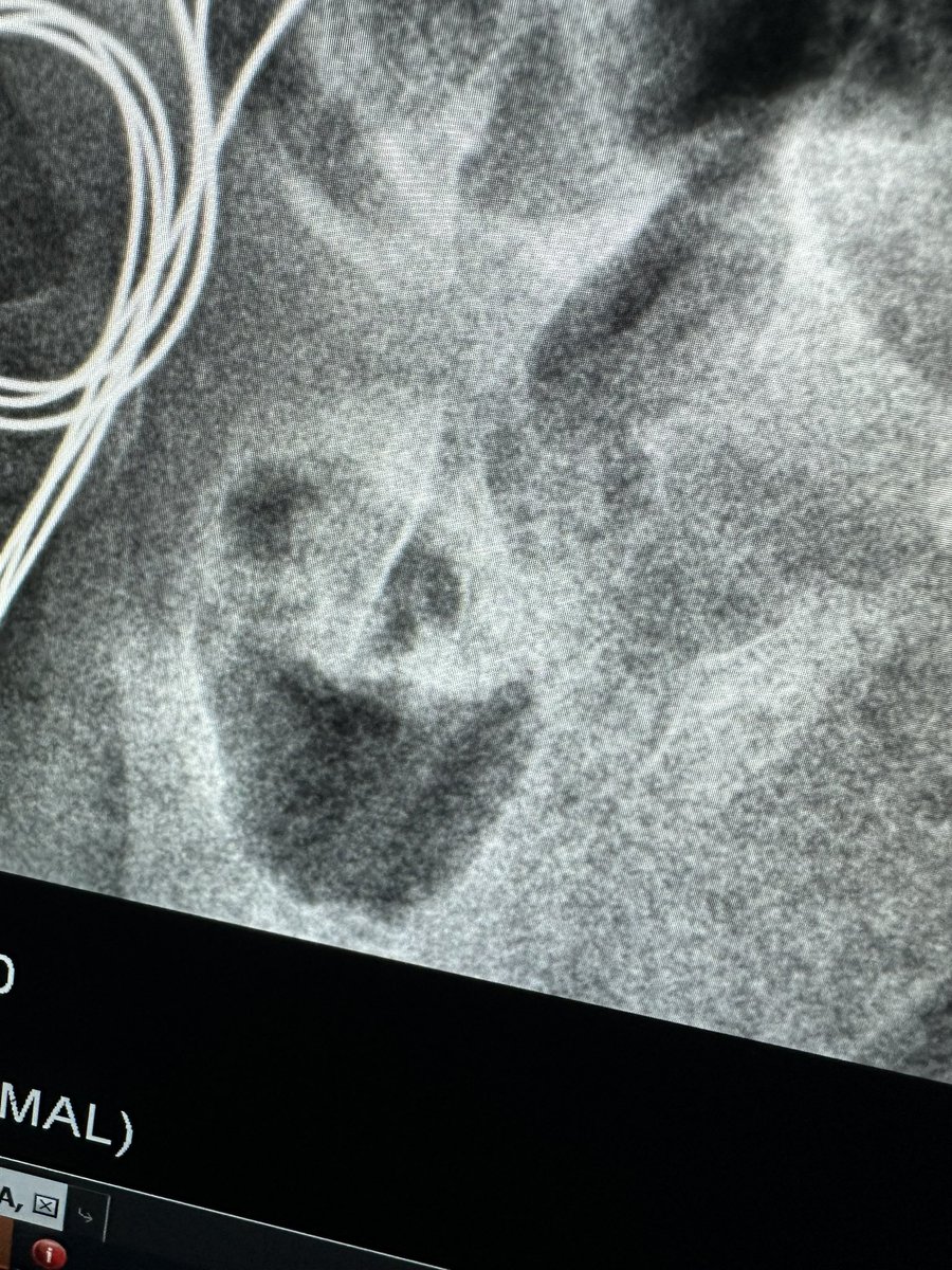 Happy little bowel in an inguinal hernia!