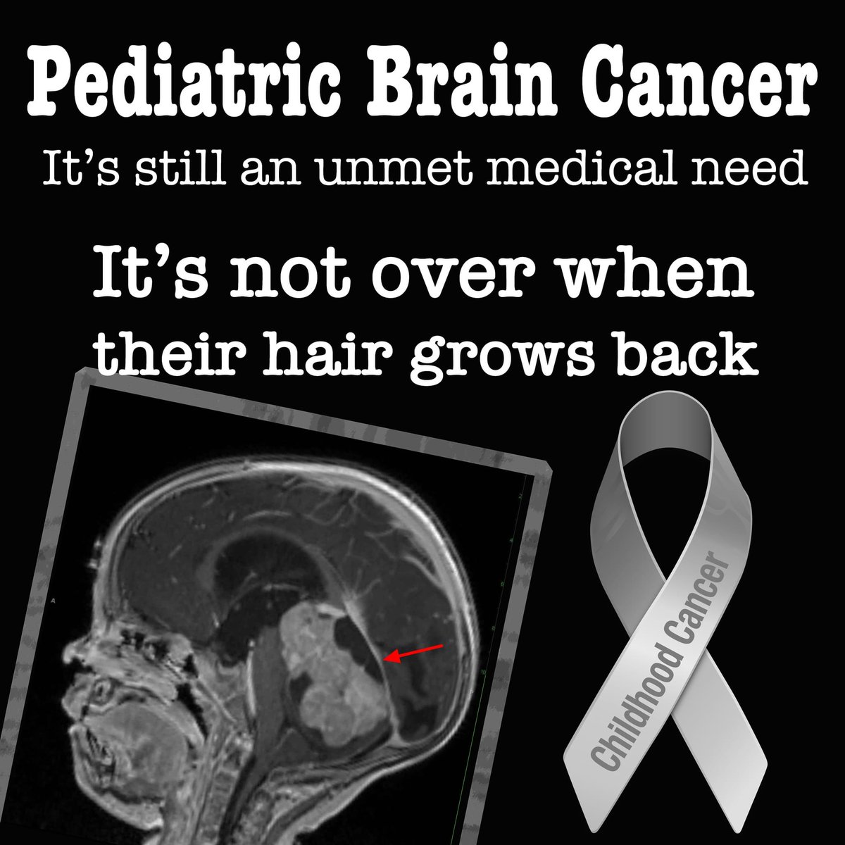 Joe Baber (@joebaber1) on Twitter photo Brain cancer, like most other #ChildhoodCancer, does not end when a child's hair grows back after chemotherapy. Pediatric Brain Cancer is an unmet medical need. Brain Cancer kills more children in the US than any other cancer. <a href="/HappyQuailPress/">Happy Quail</a> <a href="/cac2org/">CAC2</a> <a href="/AmandaHaddock/">Amanda Haddock 🧬</a> <a href="/JanHalash/">Jan Halash 🌻💙💛</a> Brain cancer, like most other #ChildhoodCancer, does not end when a child's hair grows back after chemotherapy. Pediatric Brain Cancer is an unmet medical need. Brain Cancer kills more children in the US than any other cancer. <a href="/HappyQuailPress/">Happy Quail</a> <a href="/cac2org/">CAC2</a> <a href="/AmandaHaddock/">Amanda Haddock 🧬</a> <a href="/JanHalash/">Jan Halash 🌻💙💛</a>
