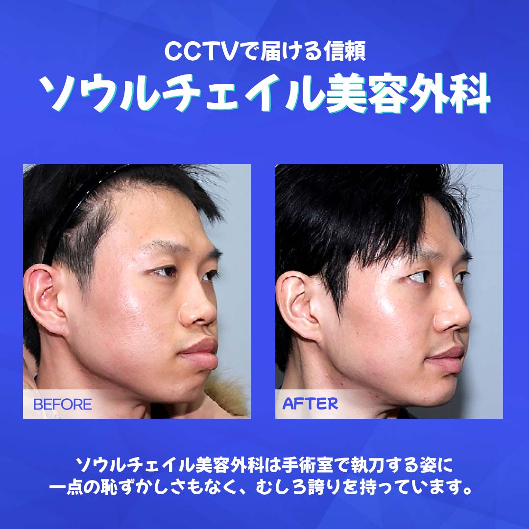 seoulcheilps's tweet photo. CCTVで届ける信頼✨

手術室のCCTVの確認を希望でしたら、
患者さんや患者さんの家族にもお見せします。
手術室で執刀する姿に一点の恥ずかしさもなく、
むしろ誇りを持っています。

患者様の安全が何よりも重要です。

#韓国整形 #韓国美容 #整形手術 #美容外科 #韓国美容外科 #輪郭整形 #美容整形 #韓国ビューティー #整形外科 #韓国旅行