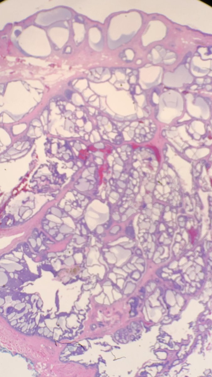 Simon_Path's tweet photo. 74F, glabellar lesion @HENRYY_MD @JMGardnerMD https://t.co/HtXSWhAM0C