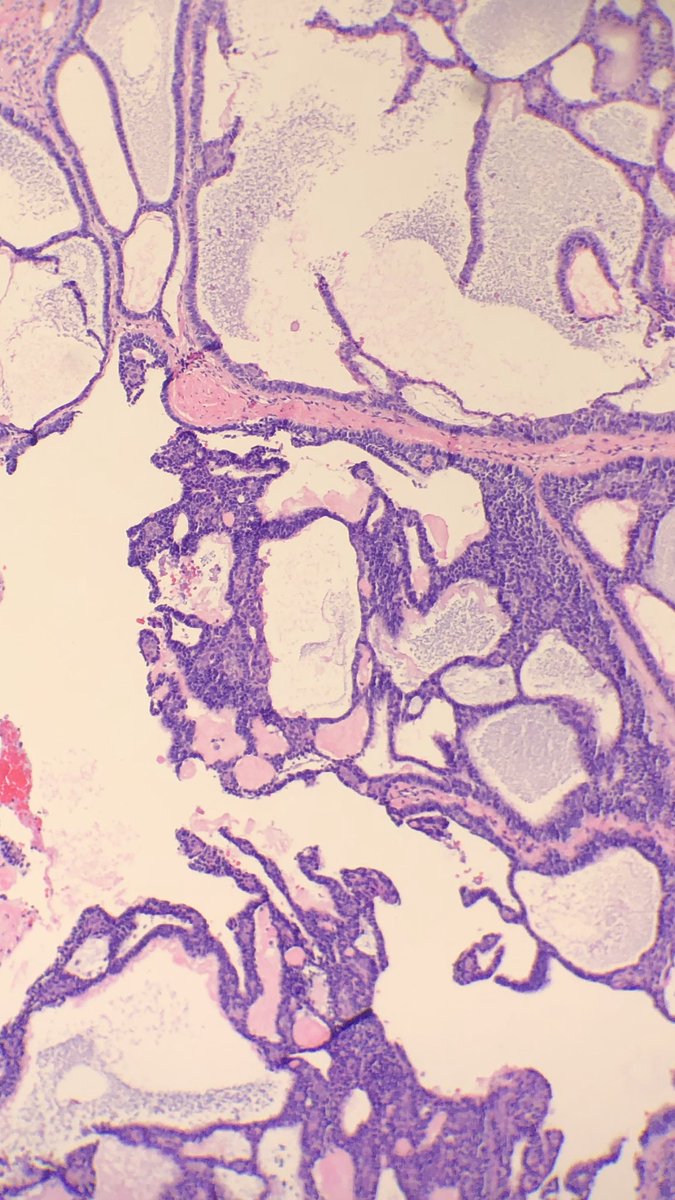 Simon_Path's tweet photo. 74F, glabellar lesion @HENRYY_MD @JMGardnerMD https://t.co/HtXSWhAM0C