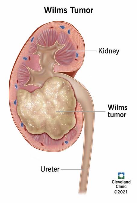 Satyayadav__'s tweet image. 06 Sept 23 

#WilmsTumor kidney tumor in children &amp;gt;90% cured 

Usually abdominal lump detected by mother while bathing the child 

Children may present with blood in urine 

#ChildhoodCancerAwarenessMonth 

#GoldSeptember 
#SupportChildrenWithCancer
#ChildhoodCancerSIOPCCI