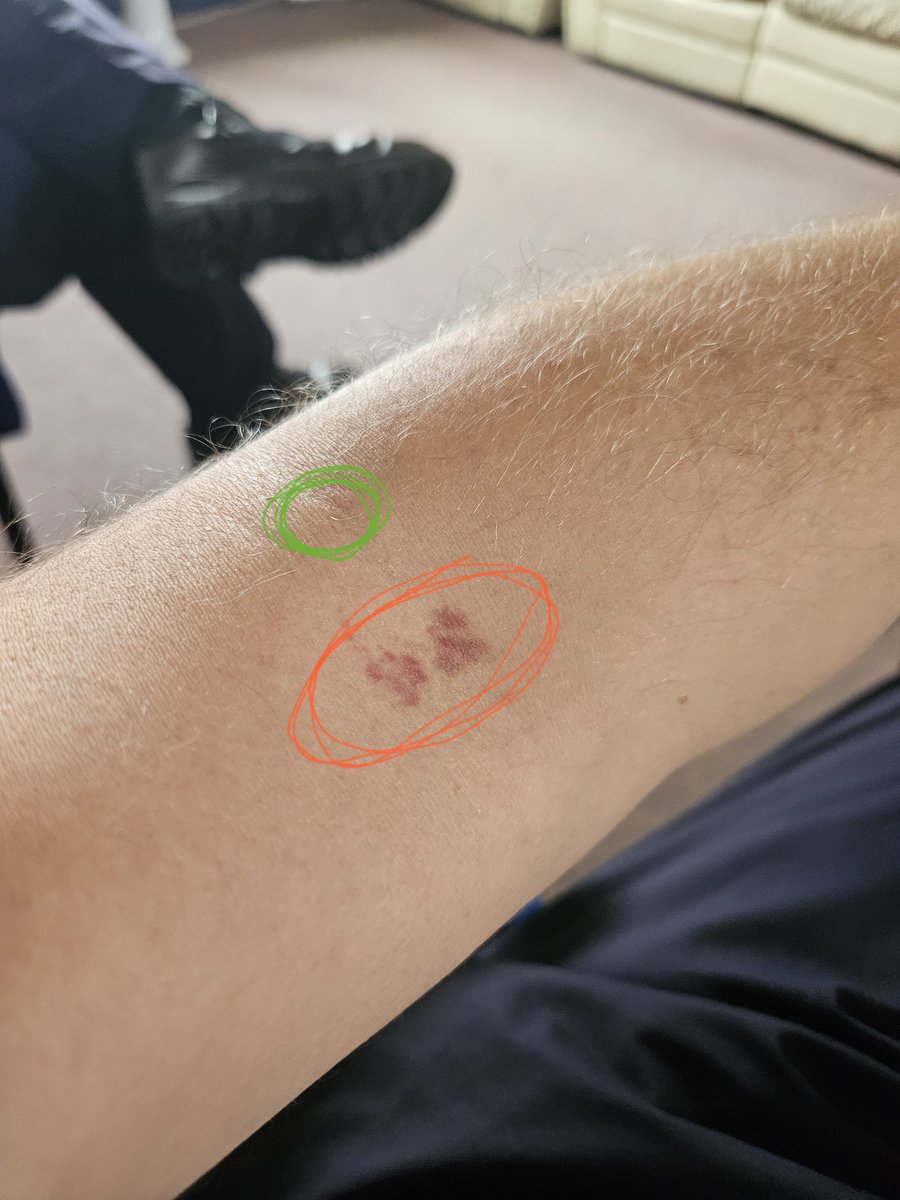 Okay, #phlebotomist of X, can some tell me why this has happened after an infusion? Green area is where infusion when in, and the red appeared right after.
