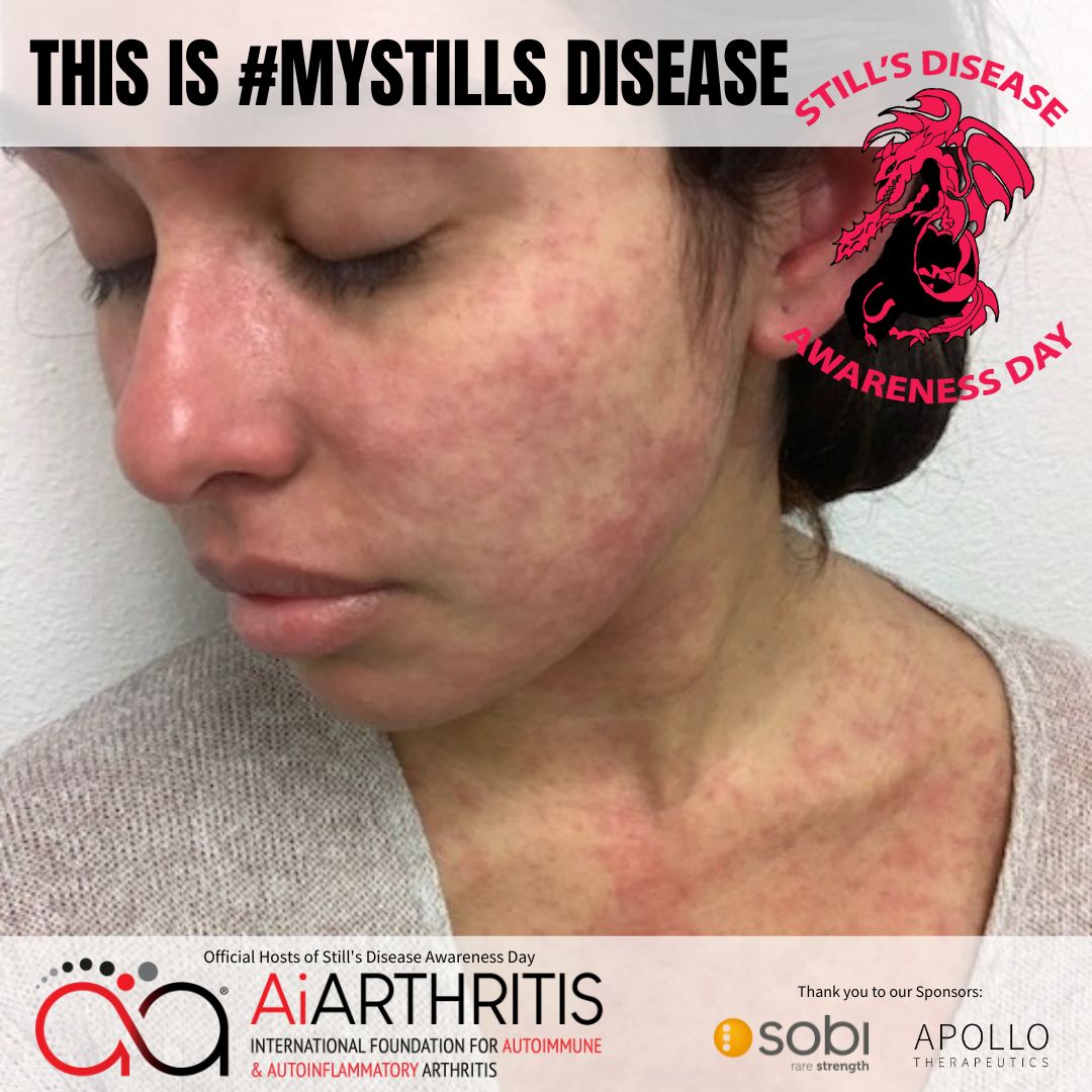 IFAiArthritis's tweet photo. Have you ever seen a #stillsdisease rash? š¤ It may be rare, but awareness is crucial in helping patients get timely diagnoses and treatment. Let's spread the word and support those affected! #MyStills #StillsDay https://t.co/TLQZNY6OCK