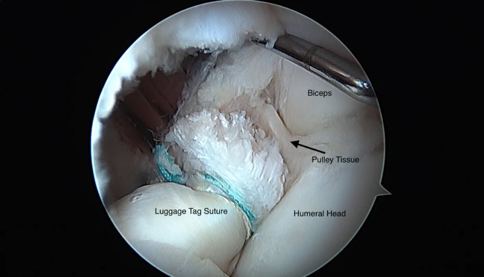 rileywilliamsMD's tweet photo. Researchers hypothesized that in the setting of a preserved anatomic biceps pulley & no LHB pathology, isolated #subscapularis repair would result in excellent clinical outcomes when compared with subscapularis repair and #biceps #tenotomy or #tenodesis. https://t.co/6EjdJwZ77f https://t.co/NdwghaGlpi