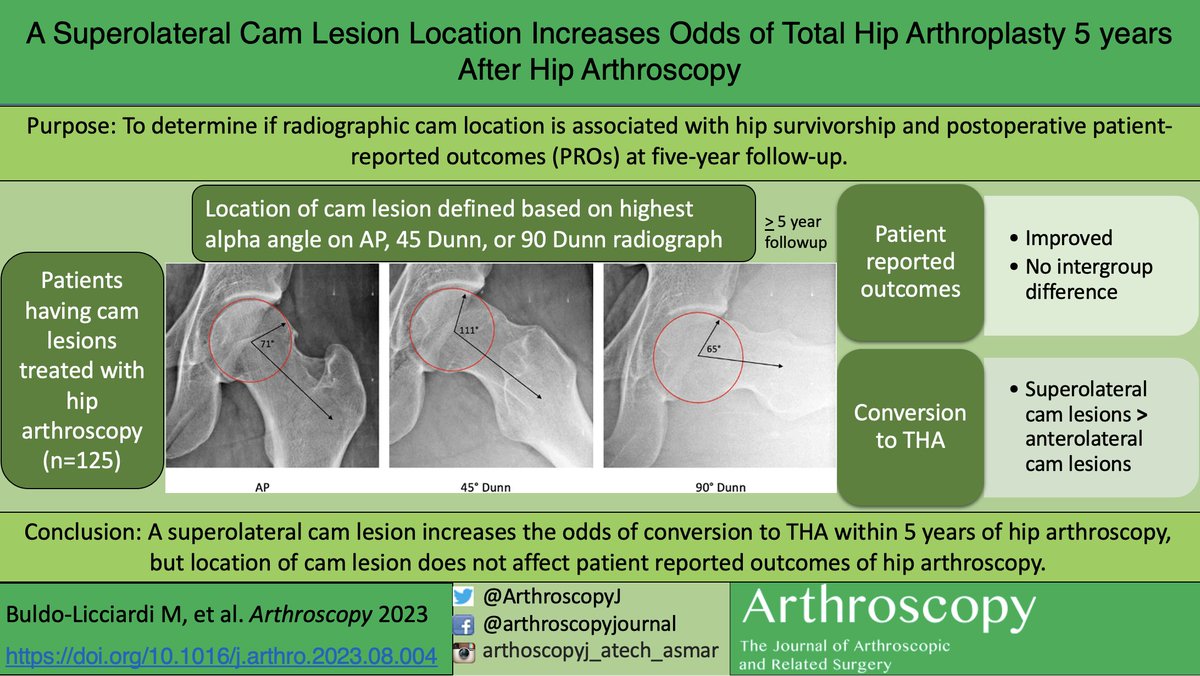 ArthroscopyJ's tweet photo. #visualabstract A Superolateral Cam Lesion Location increases Odds of Total Hip Arthroplasty 5 years after Hip Arthroscopy https://t.co/3jjiCY3Y4o @ThomasYoumMD #hip #hipscope #arthroscopy #hipreplacement https://t.co/5zo6E0bkWx