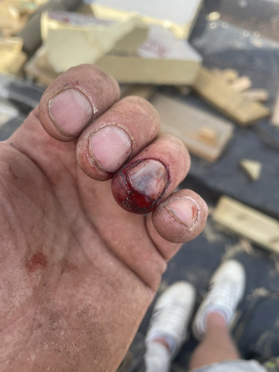 sidneybean1980's tweet photo. Always check your backswing when hammering. Might be an issue for #detectival at the weekend https://t.co/CiWFh6bwL8