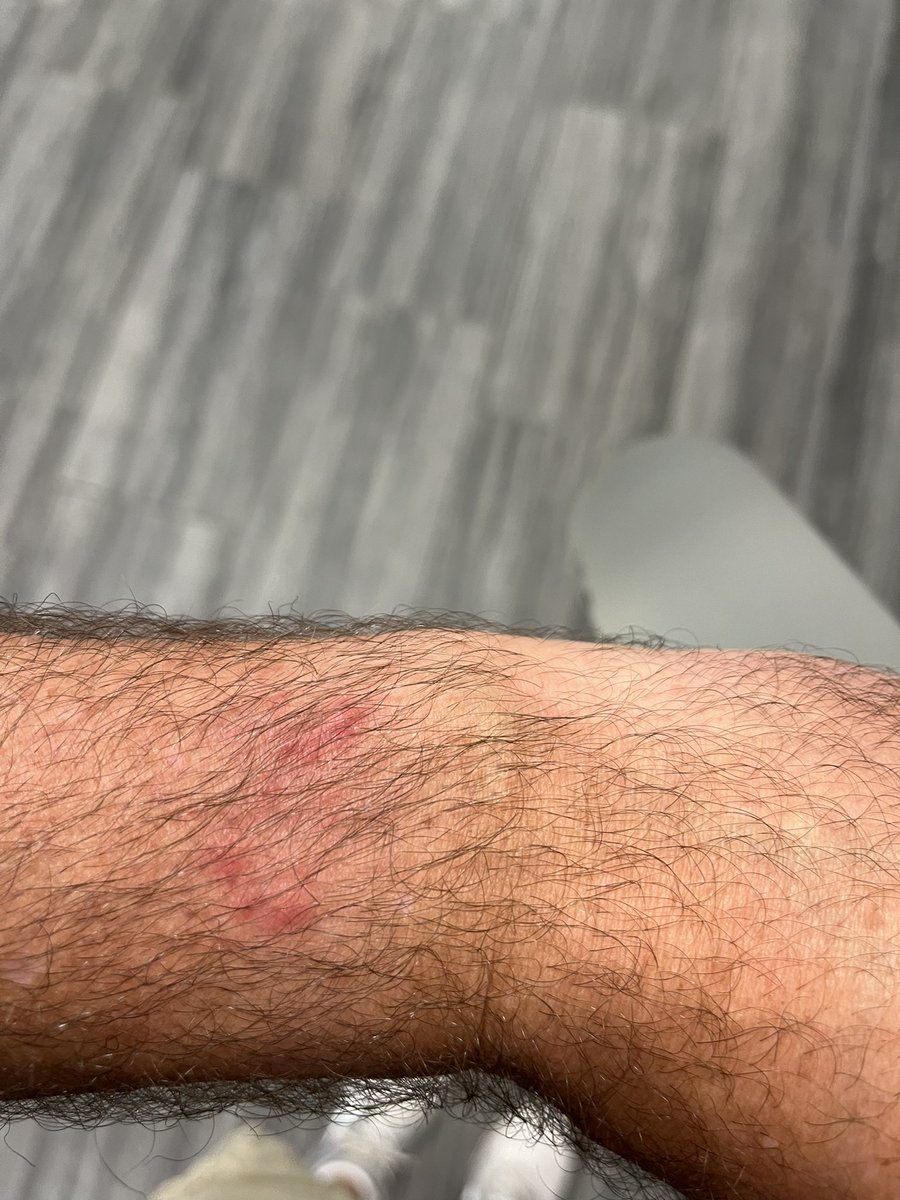 This is crazy!!! I got burn marks on my wrist from my <a href="/Apple/">Apple</a> watch!

Has this happened to anyone else?!?

#applewatch #apple