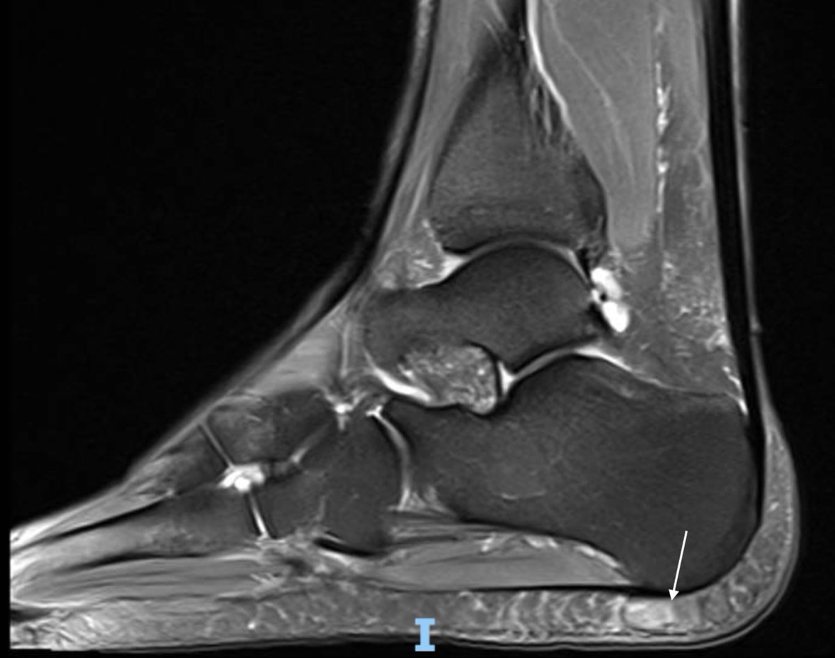 Fat Pads Atrophy Syndrome | Well Heeled Podiatry in Hampton