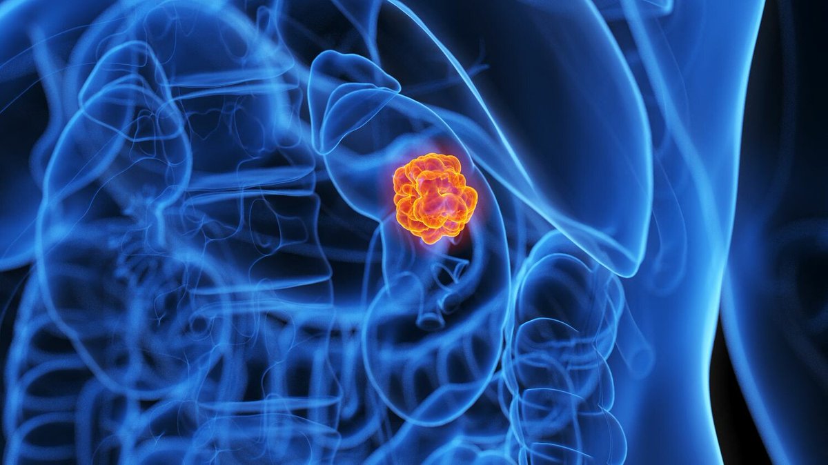 Les cas de cancer chez les moins de 50 ans ont augmenté de près de 80 % en trois décennies, selon une étude
➡️ l.francetvinfo.fr/zRv