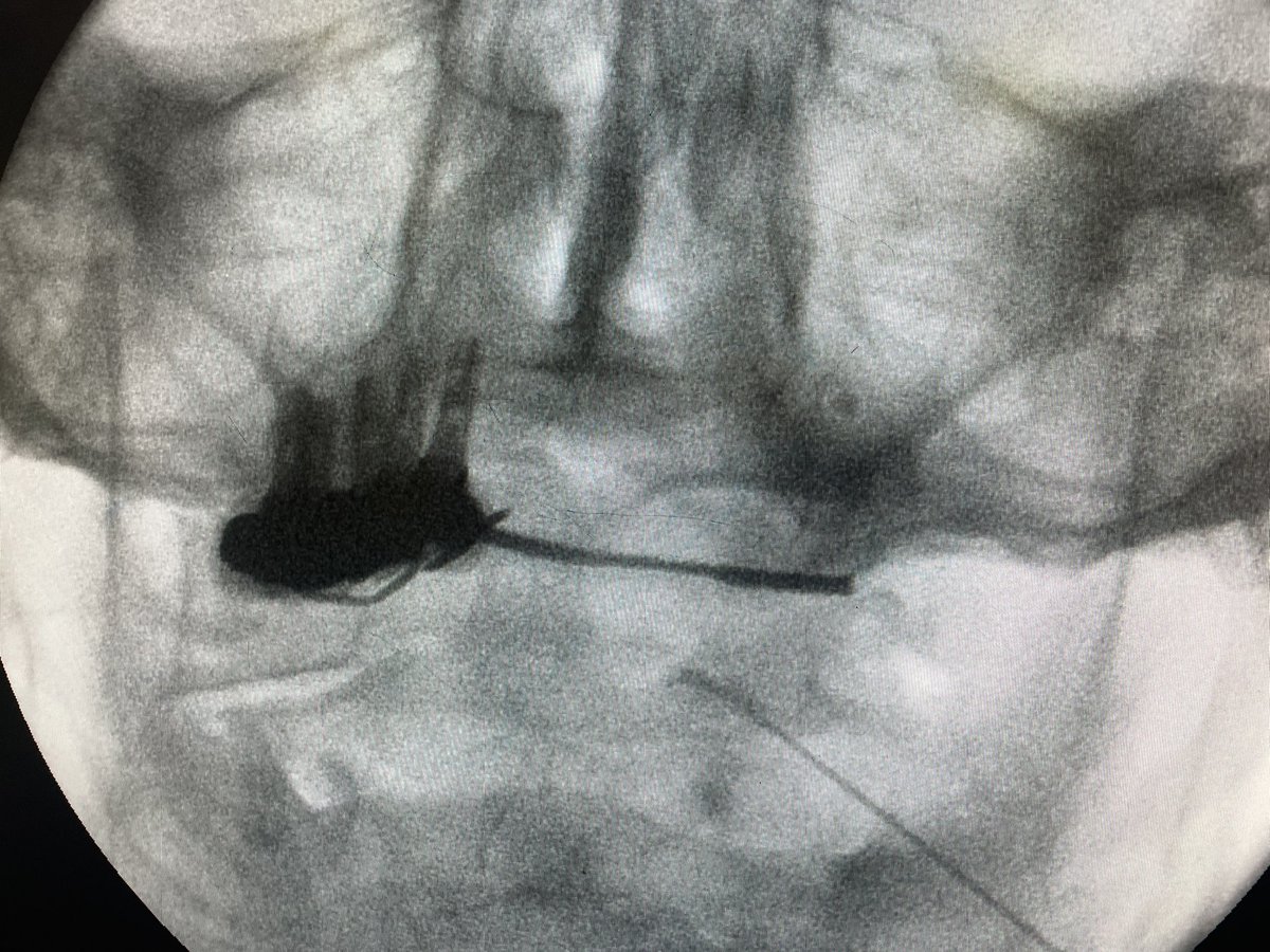 Vuelta al cole!! Bloqueo de articulación C1-C2 para dolor cervicogenico!! Clásicamente unilateral y muy incapacitante.