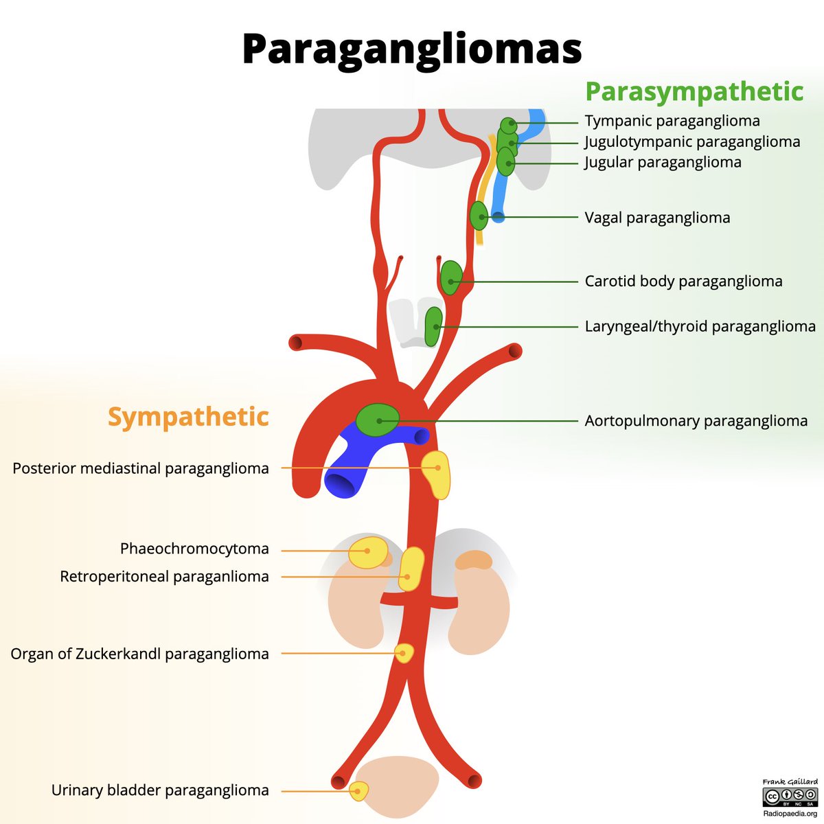 This week on the @Radiopaedia Reading Room Podcast I was joined by @SalAyesa for a “readful” episode all about paragangliomas! Plus Hamlet, possums, Eurydice and an apology to the fine people of Bundaberg, QLD. 🎧 radiopaedia.org/podcast #foamrad