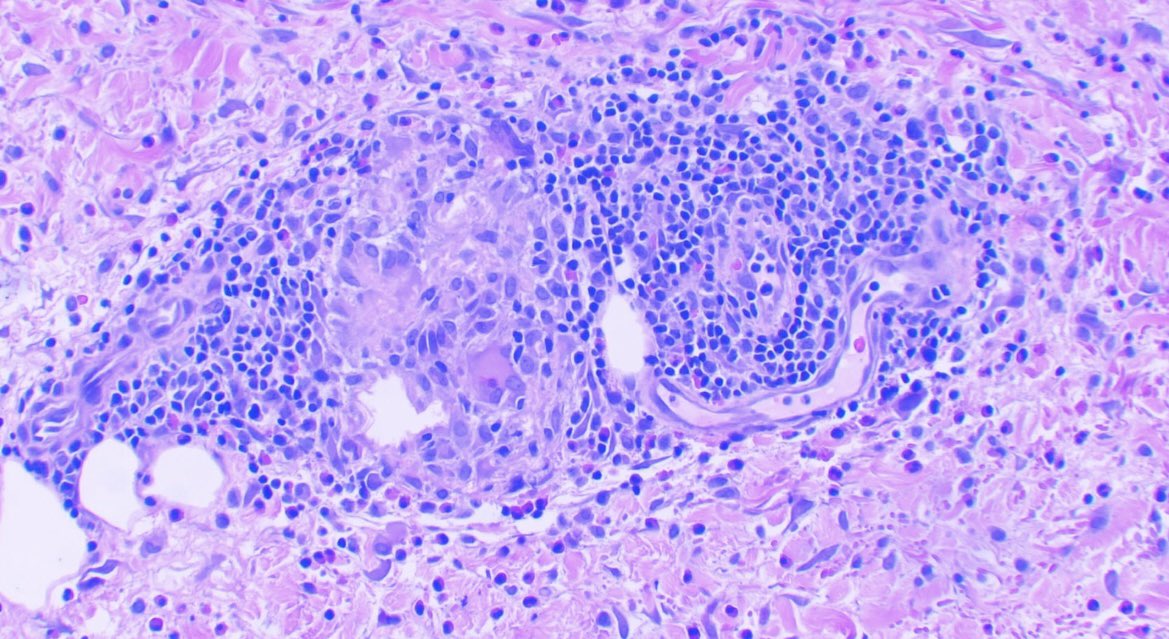 #arthropod bite reaction can show many faces: Ulceration and eosinophis are common findings. Edema of papillary dermis is not always present. Granulomas can be seen 👀 CPC is essential #PathTwitter #MedTwitter #dermatology #pathology #path #dermpath