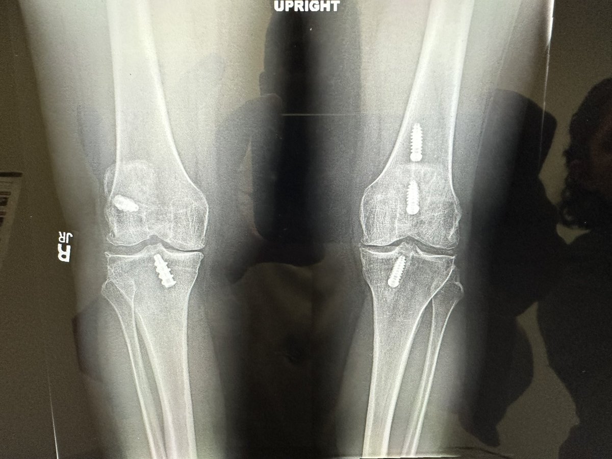 #orthotwitter

Help me make some sense of these left knee X-rays 

Single left knee ACL reconstruction with allograft in the 1990s. That’s all I got.