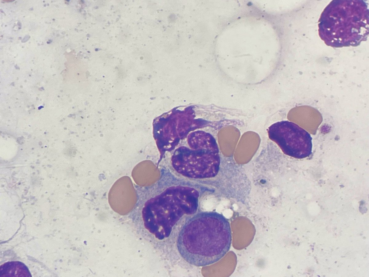 MSWPathology's tweet photo. Happy hump day! ๐ช
๐ฉตTell us you love pathology without telling us you love pathology๐ฉท
#pathology #mountsinai #metamyelocyte #heart #pathlove https://t.co/B3SFEu8kRb