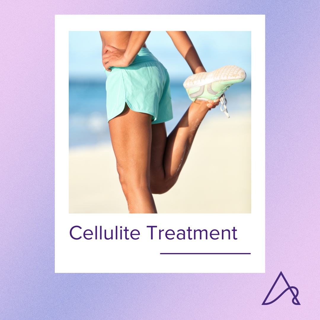 Cellulite occurs on thighs, buttocks, and hips and worsens with age due to the skin's loss of elasticity and sagging. To address cellulite, there are several treatment options available, both noninvasive and minimally invasive. 

#plasticsurgery #cellulite #cellulitetreatment