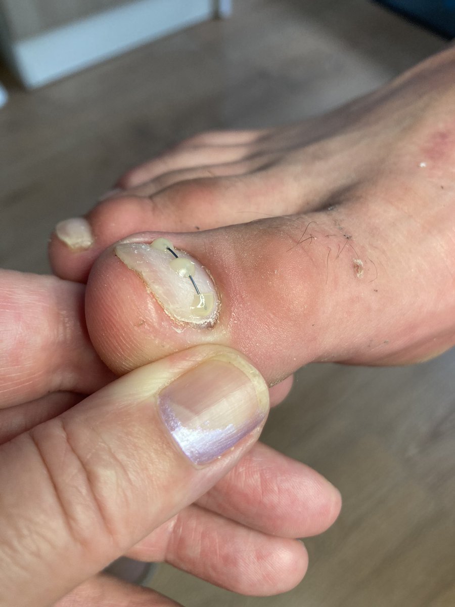 Zarůstá vám nehet?