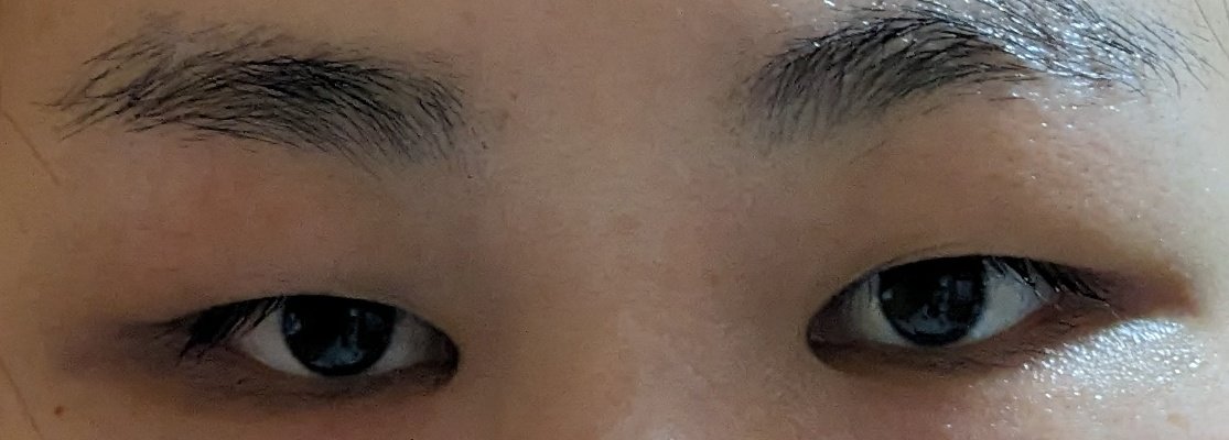 iegaiiya's tweet photo. ⚠️目整形前⚠️

皺眉筋切除したため、額の筋肉使えず更にぼってり腫れぼったくなってしまった状態です😓※皺眉筋切除は必要だったのでしました!後悔全くなし。

眉下切開のおかげで太かった自眉の形が変わったのも思わぬ副産物🥳

私と同じような目の方は眉下切開一度検討されてみてください🥹🙏🏻 https://t.co/wiqIiHmk30