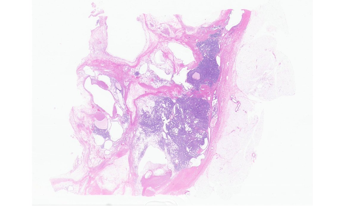 igorostixe's tweet photo. Need some help. 64yo woman with a solid-cystic encapsulated renal mass limited to kidney. Tubular and nested-cord-like architecture with clear cells basally/centrally located - not luminal (G2 max). Here some representative pics. IHQ on thread #GUpath #PathTwitter https://t.co/NwfJjEGv99
