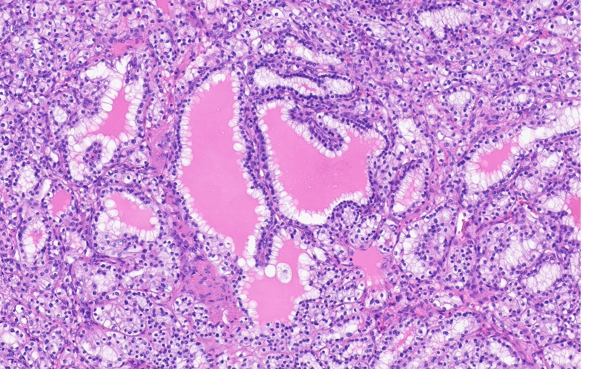 igorostixe's tweet photo. Need some help. 64yo woman with a solid-cystic encapsulated renal mass limited to kidney. Tubular and nested-cord-like architecture with clear cells basally/centrally located - not luminal (G2 max). Here some representative pics. IHQ on thread #GUpath #PathTwitter https://t.co/NwfJjEGv99