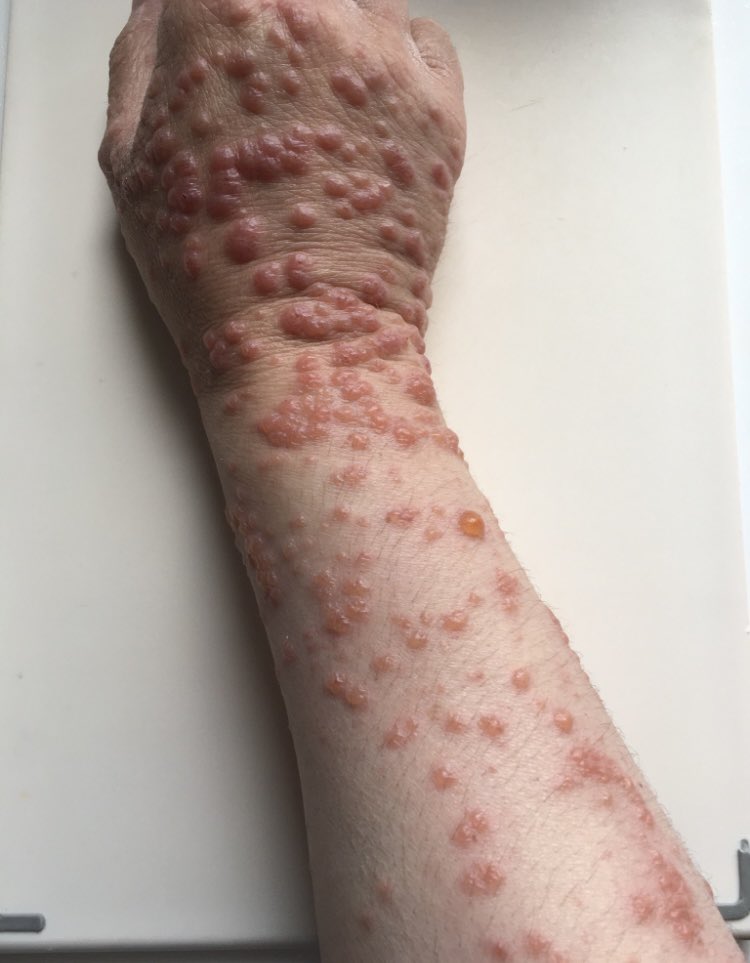 melania_jayne's tweet photo. Suffered awful side effects of the AZ jab since 2021. Refuse to stay silenced. Proven by Biopsy’s it was the AZ jab. It’s been a long road of Dermatology, Rheumatology &amp; Physio &amp; lots of medication. Pics from 2021. Still fighting. #vaccineinjured https://t.co/QYotdbz3rB