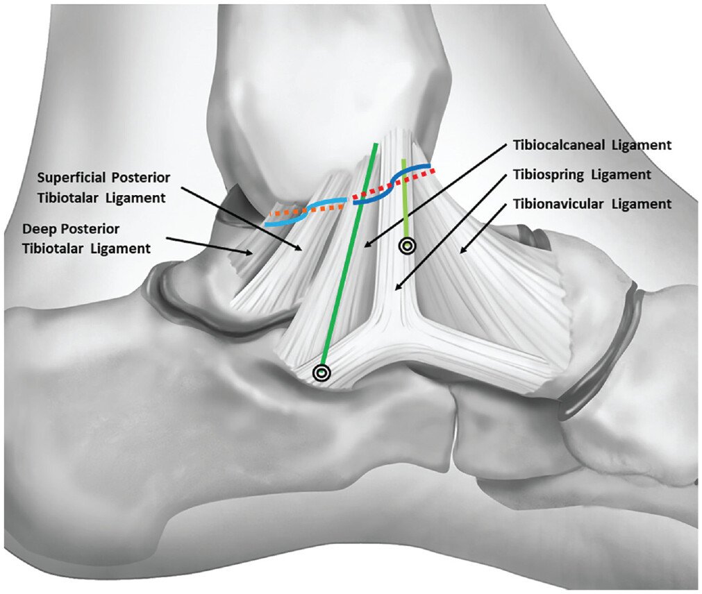 aossmjournals's tweet image. Deltoid repair with augmentation may reduce or avoid the need for prolonged postoperative immobilization and encourage accelerated rehabilitation, preventing stiffness and promoting earlier return to preinjury activity.  #ankleinstability  @SPRIVail 
doi.org/10.1177/036354…