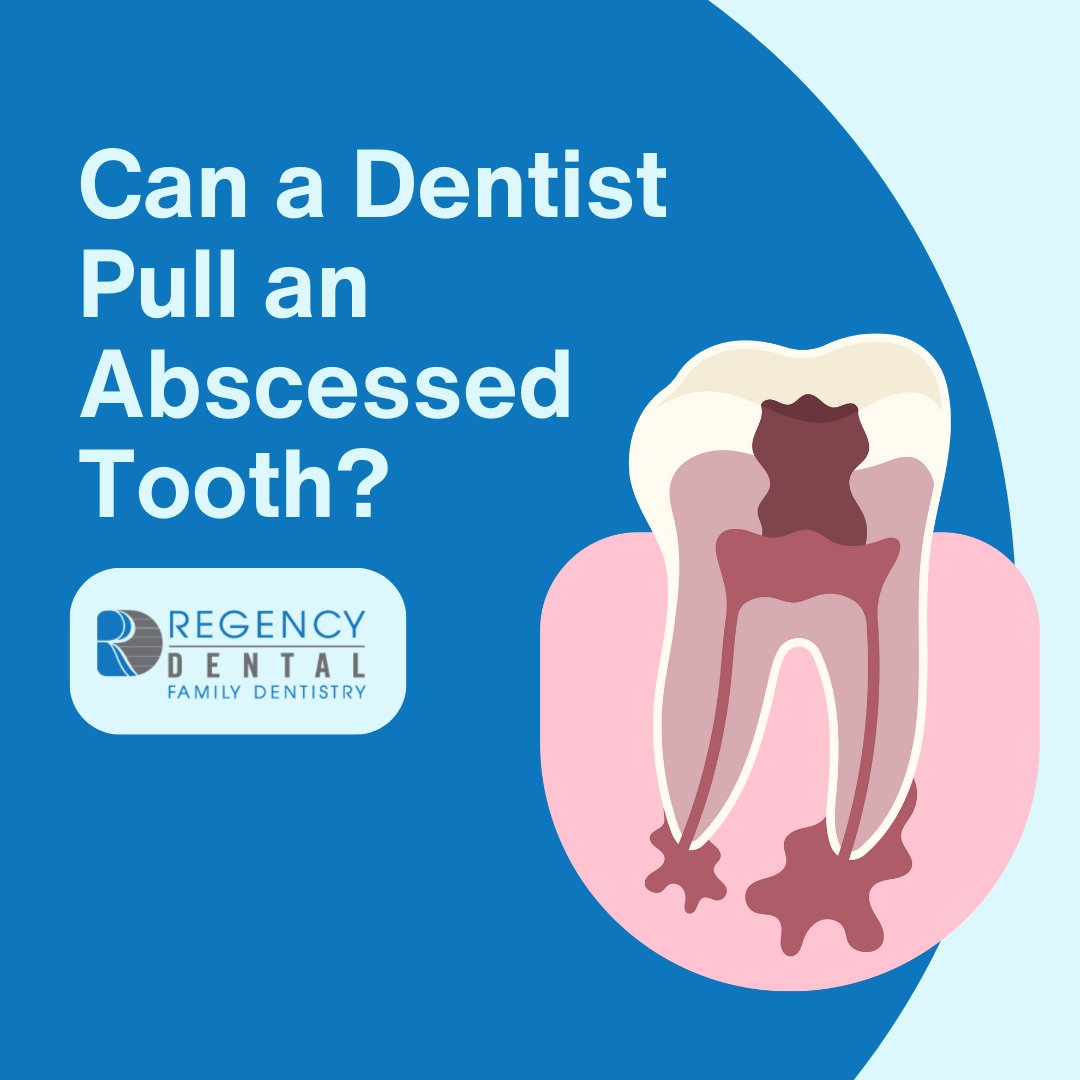 Have you ever wondered what happens to abscessed teeth? The treatment for abscessed teeth depends on the patient and their situation. Find out more about treatment for abscessed teeth in this article:
regencydentalomaha.com/can-a-dentist-…

#teeth #dentist #dentalhygiene #dentistlife